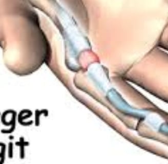 🤲 Trigger Finger & the Role of Voluntary Fasting: A Natural Healing Approach