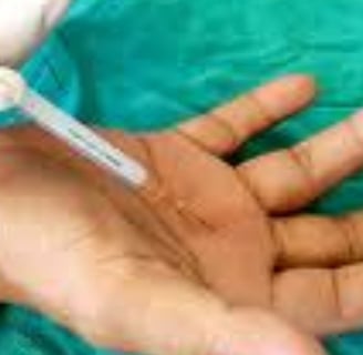 🤲 Trigger Finger & the Role of Voluntary Fasting: A Natural Healing Approach