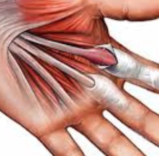 🤲 Trigger Finger & the Role of Voluntary Fasting: A Natural Healing Approach