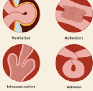 Emesis and Upper Digestive Tract Blockages