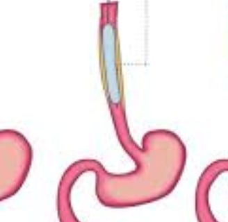 Emesis and Upper Digestive Tract Blockages