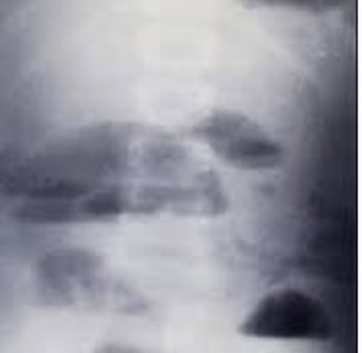 Emesis and Upper Digestive Tract Blockages