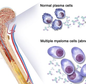 abnormal plasma cells