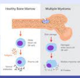 multip[e myeloma