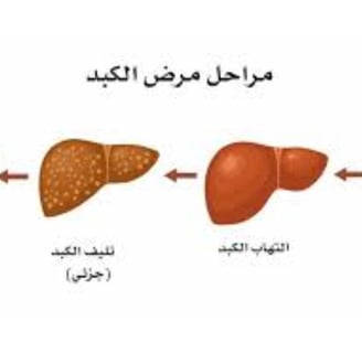 _احذروا المصير المحتوم للكبد الدهني وتشمع الكبد وتليف الكبد ودوالي المريء وسرطان الكبد (2)