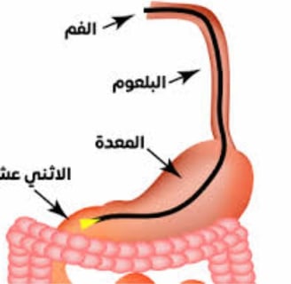 Emesis and Upper Digestive Tract Blockages
