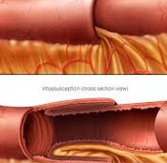 Emesis and Upper Digestive Tract Blockages