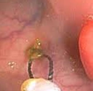 Emesis and Upper Digestive Tract Blockages