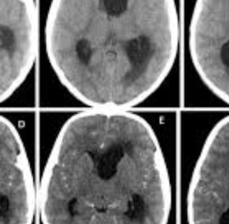 Hydrocephalus   increased CSF in the ventricles (fluid-filled cavities) of the brain by obstruction 