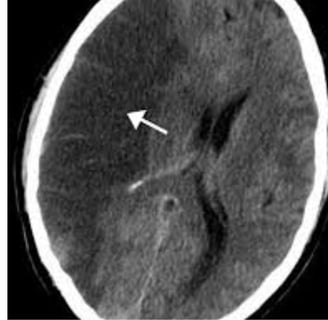 A stroke may damage the tissue that produces obstruction CSF or block the flow of CSF