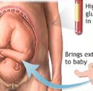 gestational diabetes