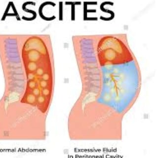 Abdominal Paracentesis ascites