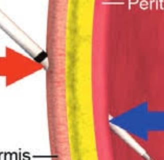 Abdominal Paracentesis Diagnostic and Therapeuti