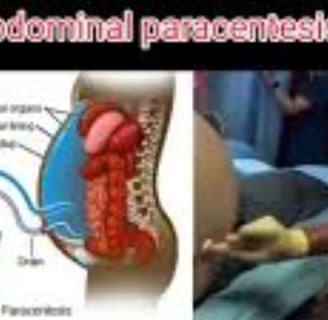 Abdominal Paracentesis Diagnostic and Therapeutic