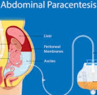 peritoneocentesis or laparocentesis, is a medical procedure