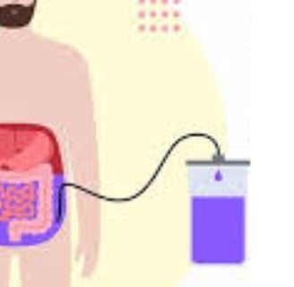 Abdominal Paracentesis Diagnostic and Therapeutic complementary issues