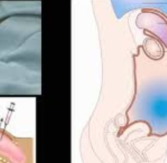 Abdominal Paracentesis Diagnostic and Therapeutic