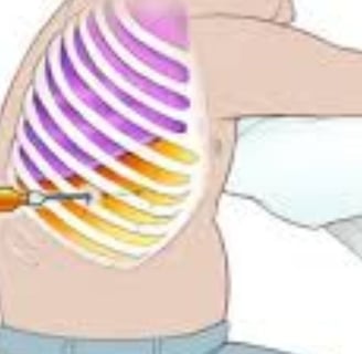 Abdominal Paracentesis Diagnostic thoracentesis