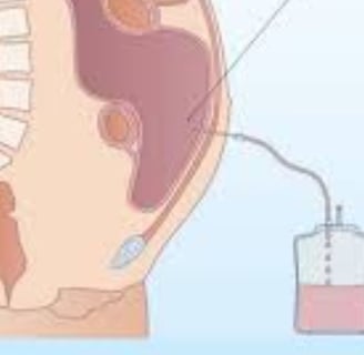 Abdominal Paracentesis diagnstic theraputc