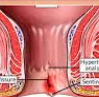 Anal fissures
