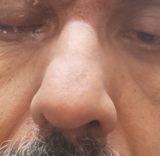 application of honey to eyes
