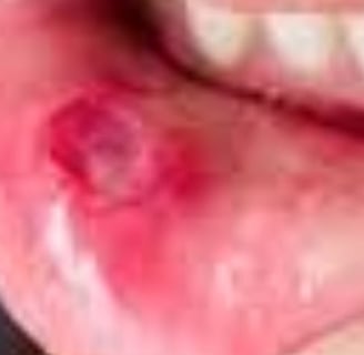 Behçet's Disease : A Comprehensive Overview and Treatments