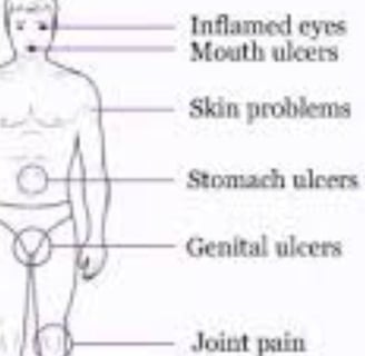 behçet's disease treatment