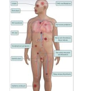 behçet's disease diagnostic criteria