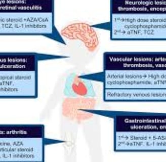 behçet's disease