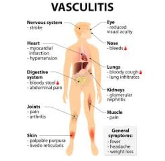 vasculitis