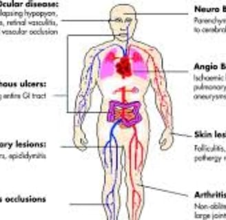 behçet's disease diagnostic criteria