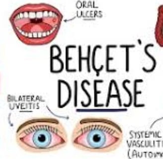 behçet's disease diagnostic criteria
