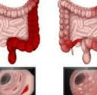Bleeding Per Anus