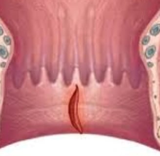 Bleeding Per Anus And Only Free Treatment