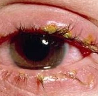 bepharitis