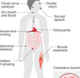 Botulism Separating Fact from Fiction (2)