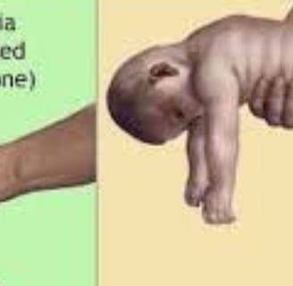 hypotonia