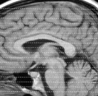 ct scan