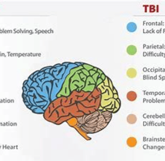 tbi