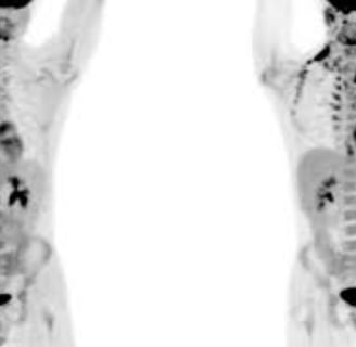 Brown Fat: Energy, Cold, Fasting, and Diseases