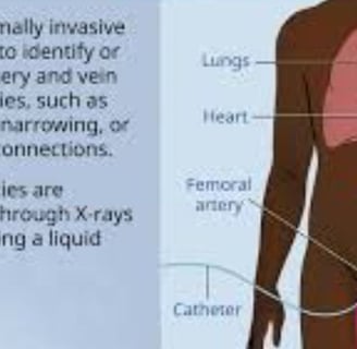 Cardiac Catheterization Why Every Case Is Followed by a Stent