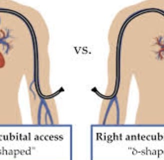 Cardiac Catheterization Why Every Case Is Followed by a Stent (3)