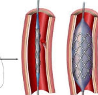 Cardiac Catheterization: Why Every Case Is Followed by a Stent