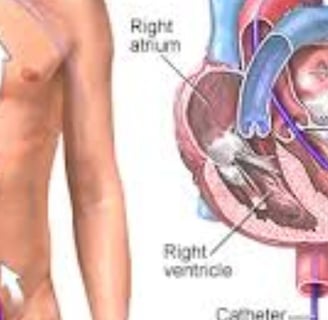 Cardiac Catheterization: Why Every Case Is Followed by a Stent