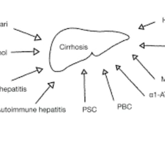 causes and symptoms liver cirhosis