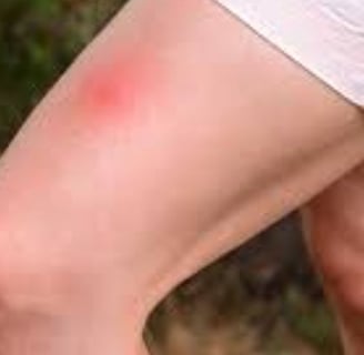 Complete Guide to Bee Stings  Treatment option , 