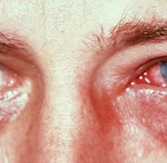 conjunctivitis