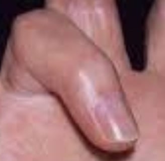 🤲 Trigger Finger & the Role of Voluntary Fasting: A Natural Healing Approach