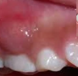 Dental Abscess