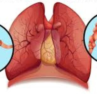 Bronchial asthma
